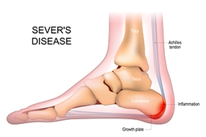 Causes and Impact of Sever’s Disease