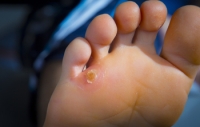 Foot Corns and Their Impact