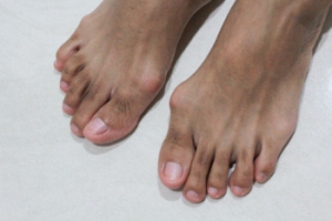Bunion Causes and Symptoms