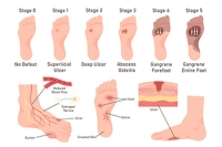 How Diabetes Affects the Feet