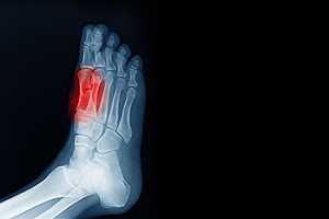 Sesamoiditis and Its Impact on Foot Health