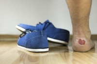 Foot Friction Blisters and Prevention