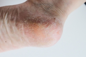 Dry Skin and Cracked Heels