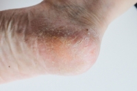 Dry Skin and Cracked Heels